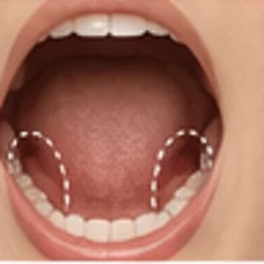 Tonsillectomy