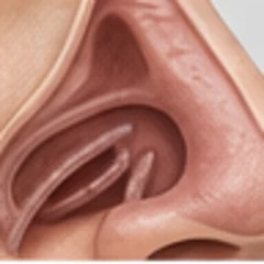 Turbinate surgery