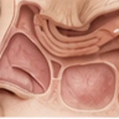 Sinus surgery (FESS)