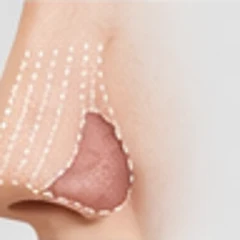 Nasal valve correction