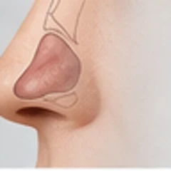 Septoplasty