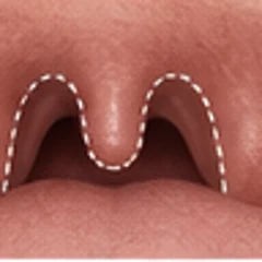 Uvulopalatoplasty